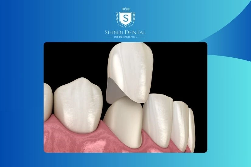 Giá bọc răng sứ Giá bọc răng sứ