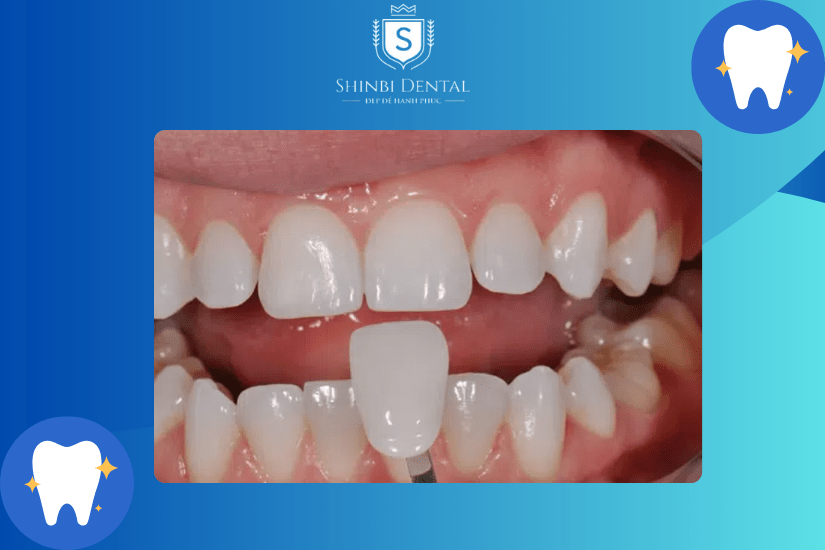Bọc răng sứ cho răng cửa bị hô gần như không đau Bọc răng sứ cho răng cửa bị hô gần như không đau