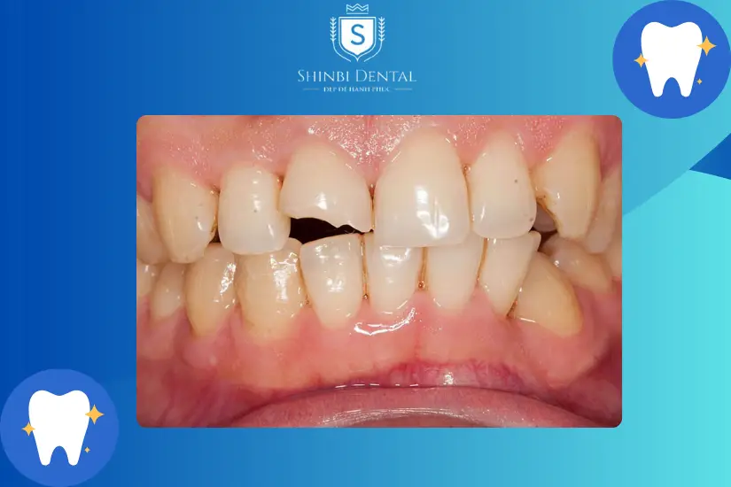 Bọc răng sứ cho răng gãy vỡ ít Bọc răng sứ cho răng gãy vỡ ít