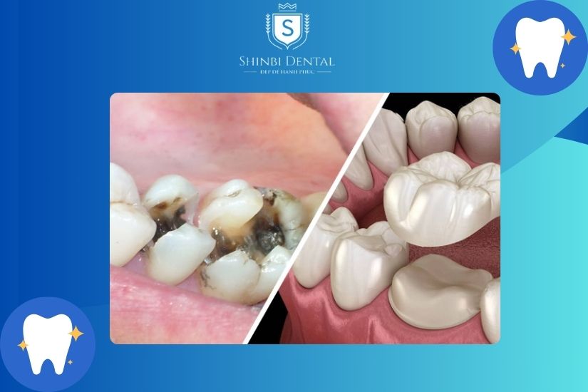 Bọc sứ giúp hạn chế tình trạng sâu răng lây lan Bọc sứ giúp hạn chế tình trạng sâu răng lây lan