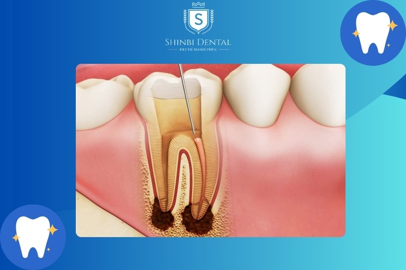 Những trường hợp nên bọc sứ cho răng sâu Những trường hợp nên bọc sứ cho răng sâu