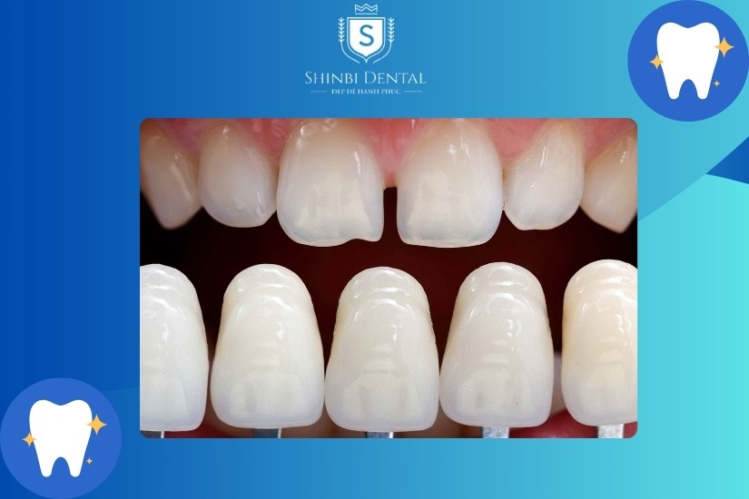 Bọc sứ giúp bảo vệ răng tự nhiên hiệu quả Bọc sứ giúp bảo vệ răng tự nhiên hiệu quả