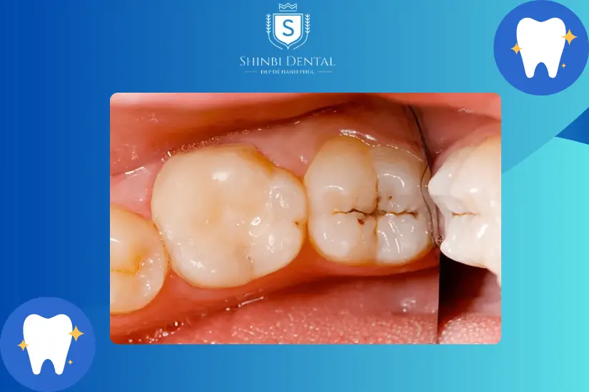 Răng sâu nhẹ nên bọc răng sứ Răng sâu nhẹ nên bọc răng sứ