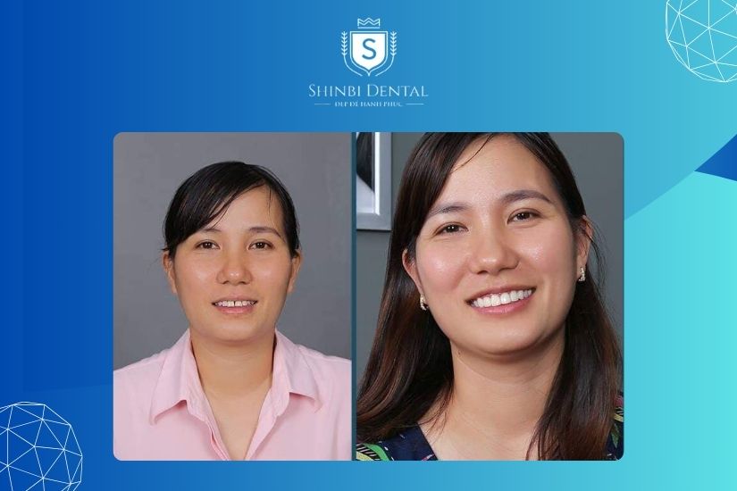 Bọc sứ răng thưa điều trị khe hở giữa răng hiệu quả Bọc sứ răng thưa điều trị khe hở giữa răng hiệu quả