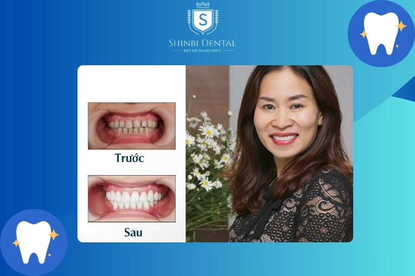 Quá trình bọc giúp hạn chế kẽ hở cách hiệu quả Quá trình bọc sứ giúp hạn chế kẽ hở cách hiệu quả