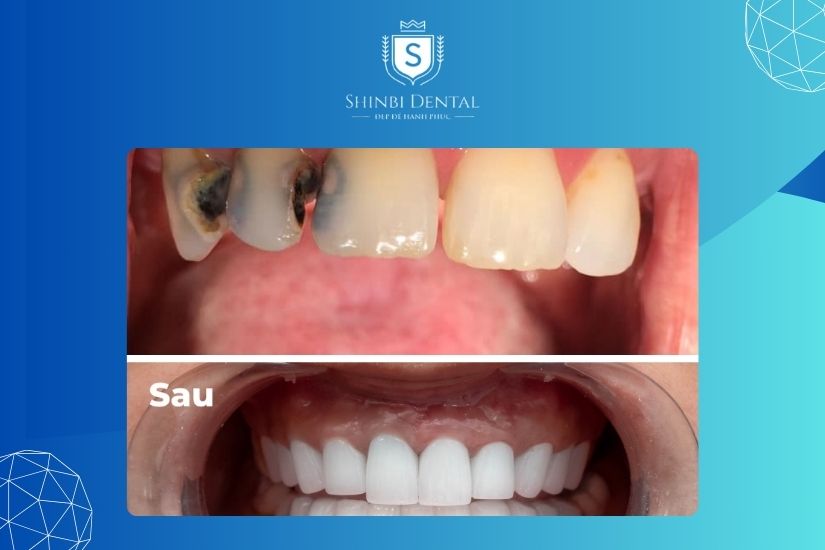 Bọc răng sứ cho răng sâu giúp gia tăng tính thẩm mỹ Bọc răng sứ cho răng sâu giúp gia tăng tính thẩm mỹ