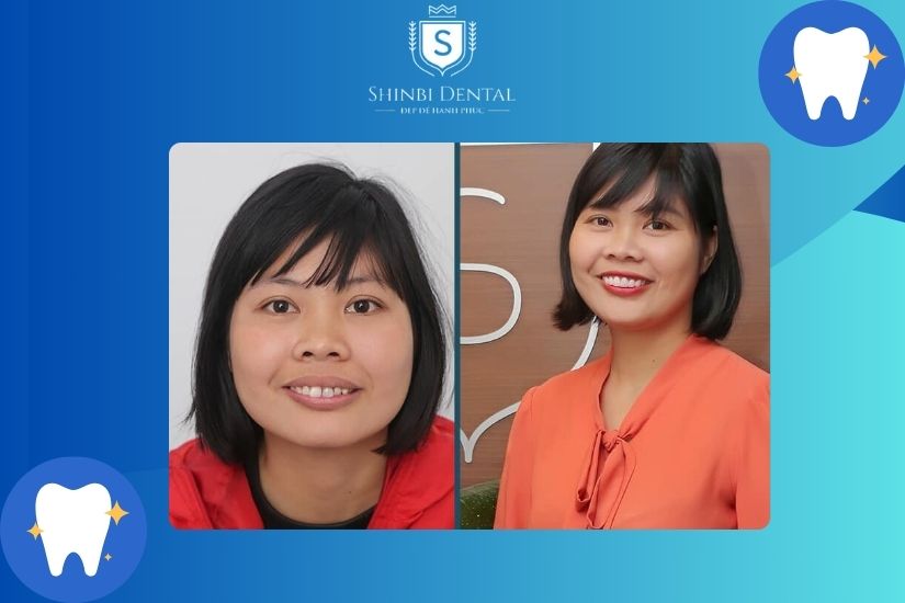 Lớp mão sứ được sản xuất với màu tương tự răng tự nhiên Lớp mão sứ được sản xuất với màu tương tự răng tự nhiên