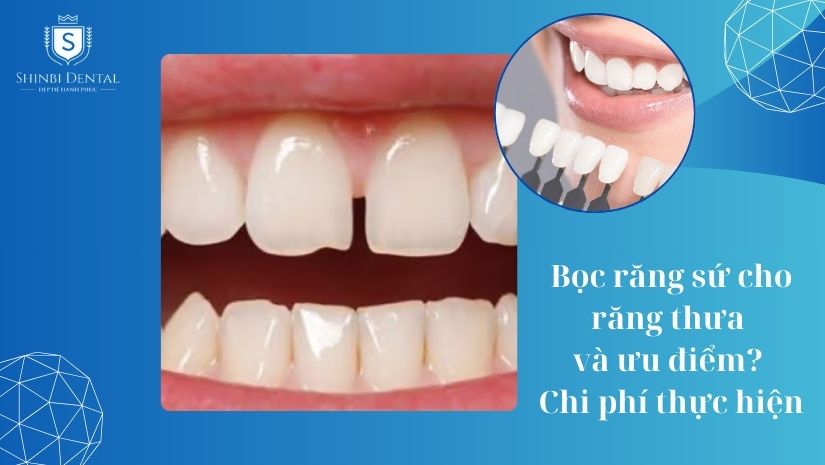 Chi phí bọc răng sứ cho răng thưa bao nhiêu tiền?
