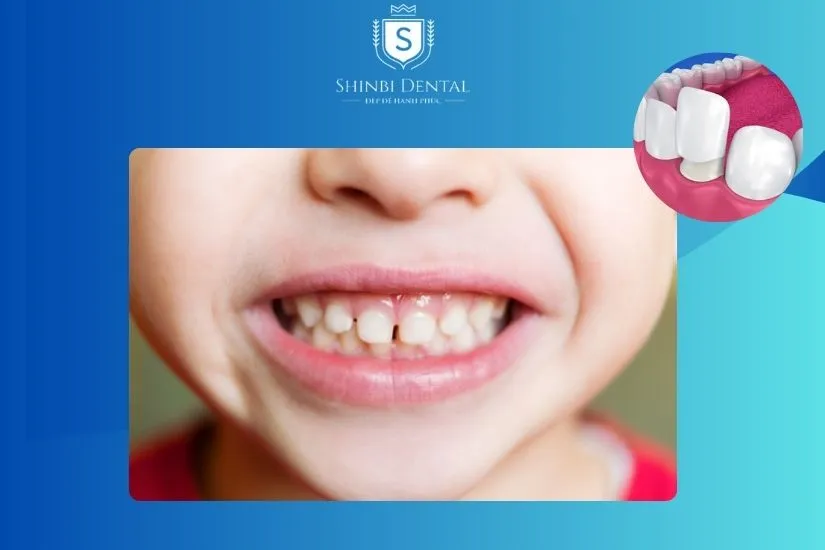 Không nên bọc răng sứ cho bé, đặc biệt là răng sữa