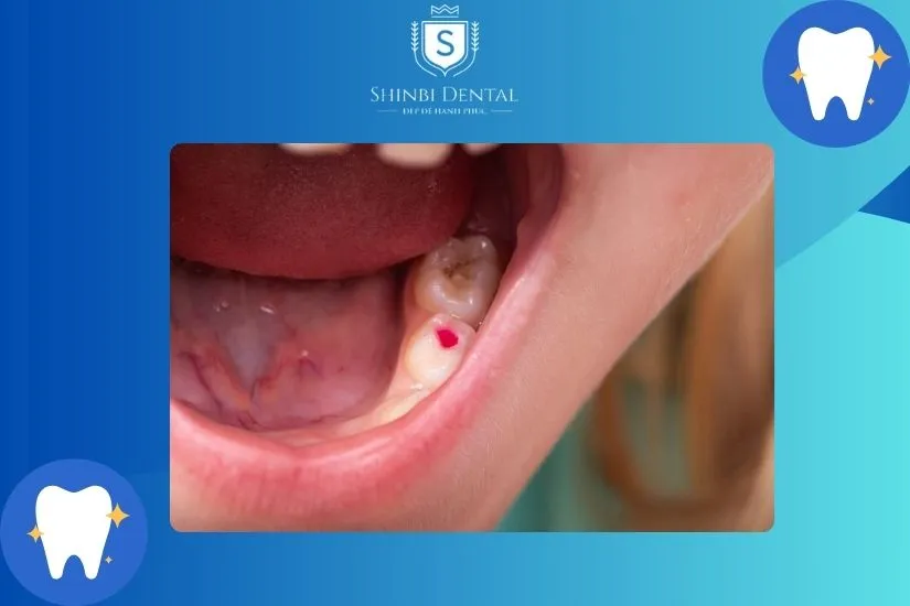 Răng vĩnh viễn của trẻ đã được điều trị tủy có thể bọc sứ