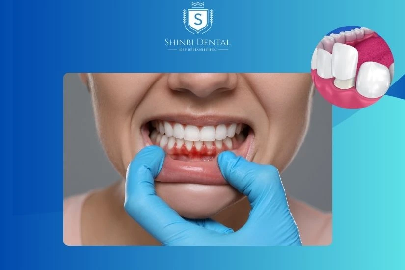 Bọc răng sứ không gây tụt lợi