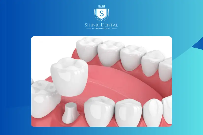 Bọc răng sứ gần như không đau Bọc răng sứ gần như không đau