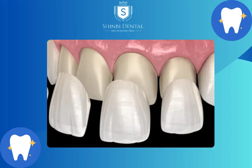 Bọc răng sứ không mài răng hay gọi là dán sứ Veneer Bọc răng sứ không mài răng hay gọi là dán sứ Veneer