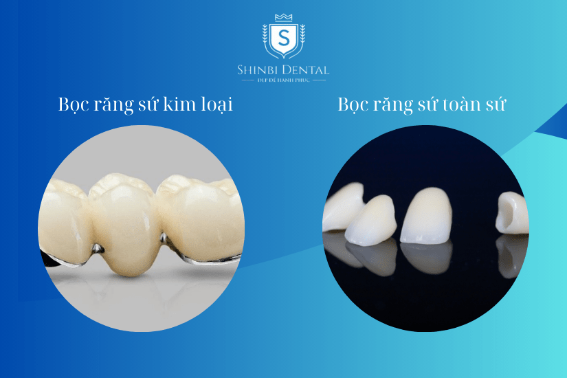 Chọn bọc răng sứ kim loại hoặc toàn sứ Chọn bọc răng sứ kim loại hoặc toàn sứ