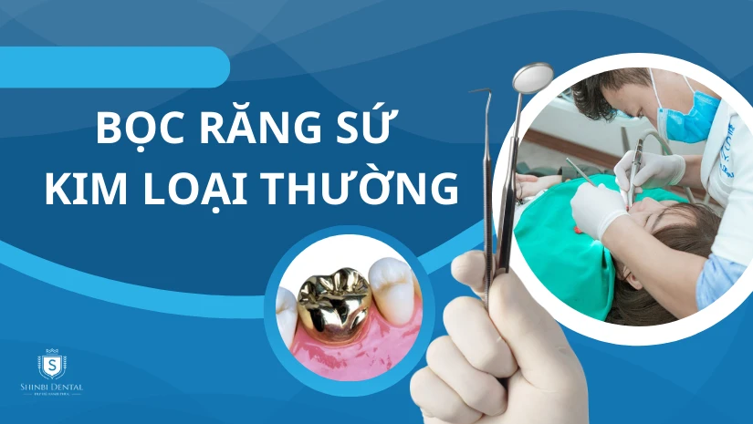Bọc răng sứ kim loại thường có tốt không? Mức giá