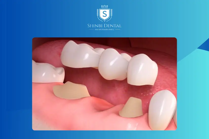Khái niệm bọc răng sứ Khái niệm bọc răng sứ