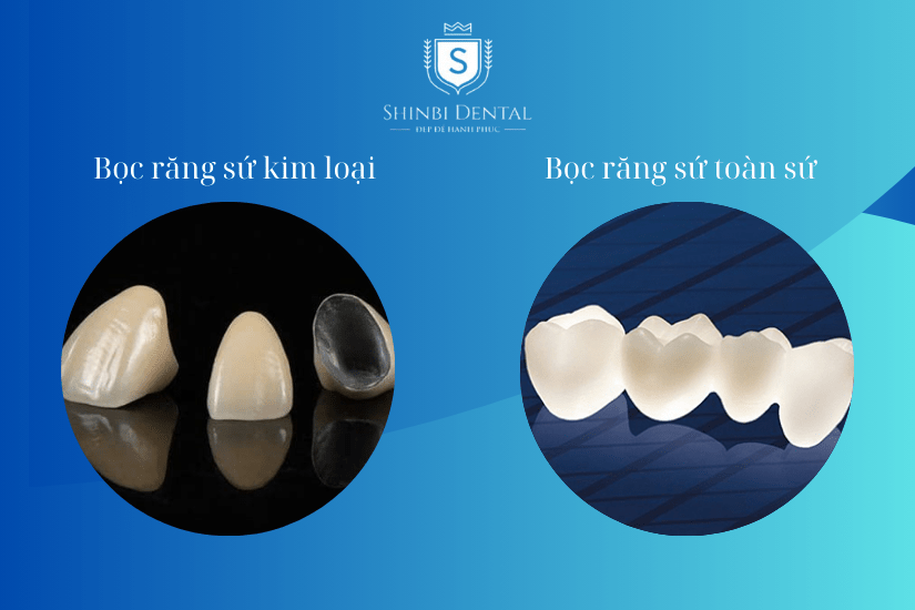 Chọn loại răng sứ bọc răng cửa bị hô Chọn loại răng sứ bọc răng cửa bị hô