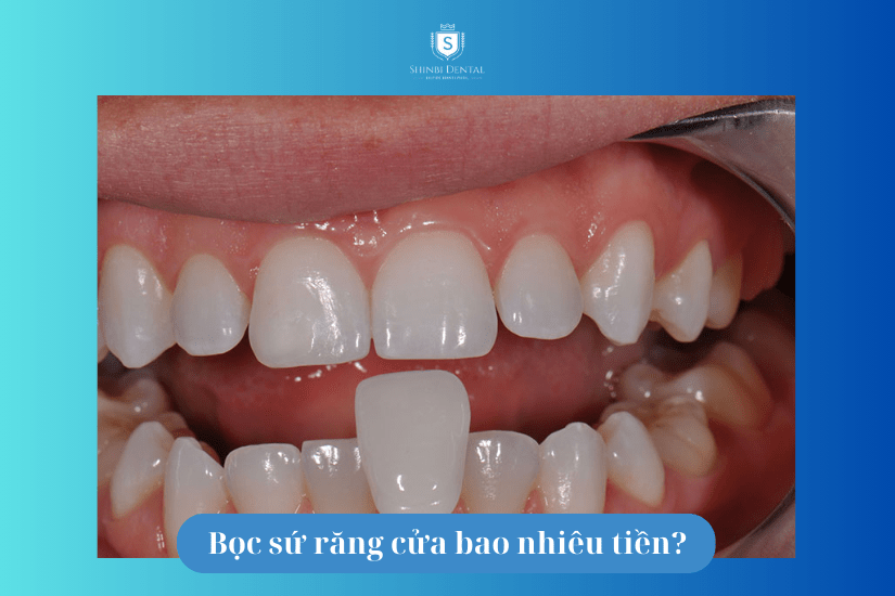 chi phí bọc răng sứ răng cửa chi phí bọc răng sứ răng cửa