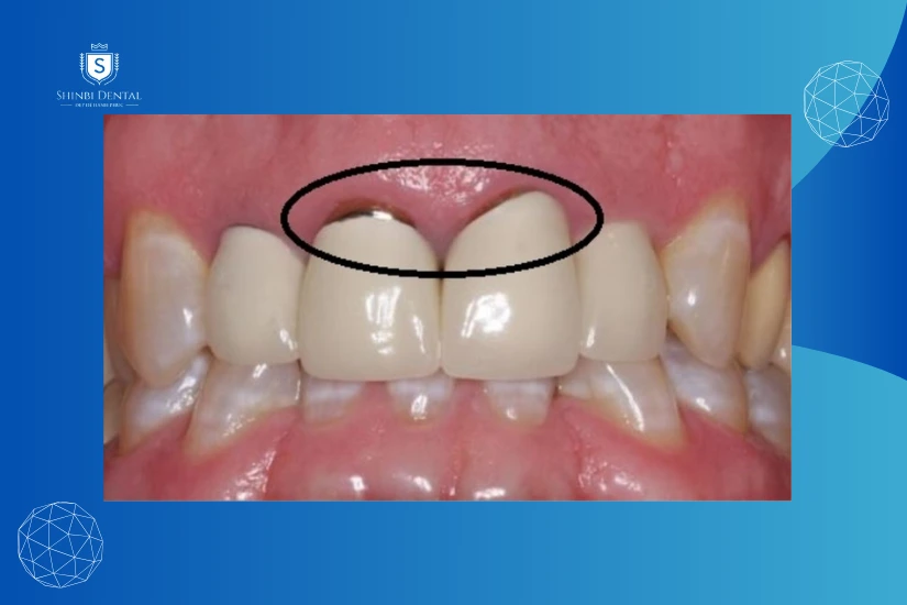 Bọc răng sứ titan bị đen sau thời gian sử dụng Bọc răng sứ titan bị đen sau thời gian sử dụng