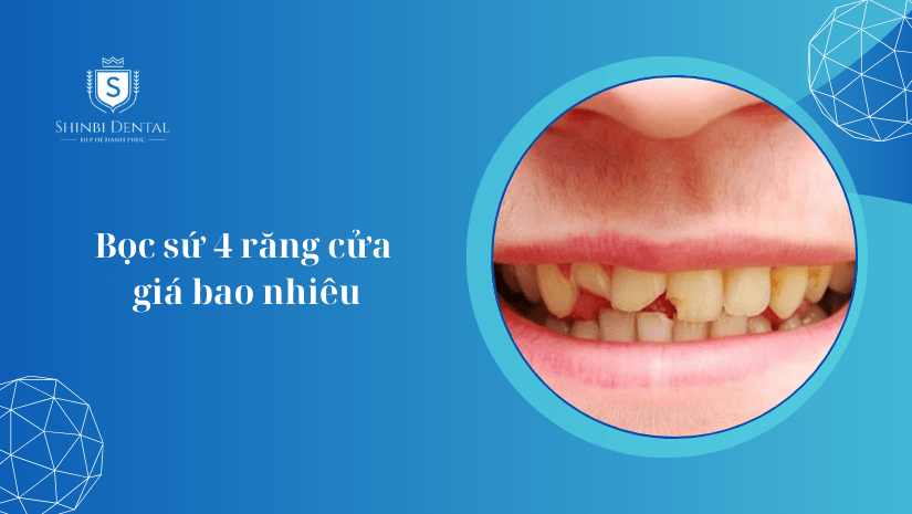 Bọc sứ 4 răng cửa giá bao nhiêu? Các yếu tố ảnh hưởng tới giá