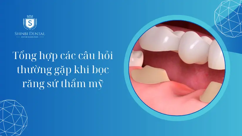 Các câu hỏi thường gặp khi bọc răng sứ thẩm mỹ