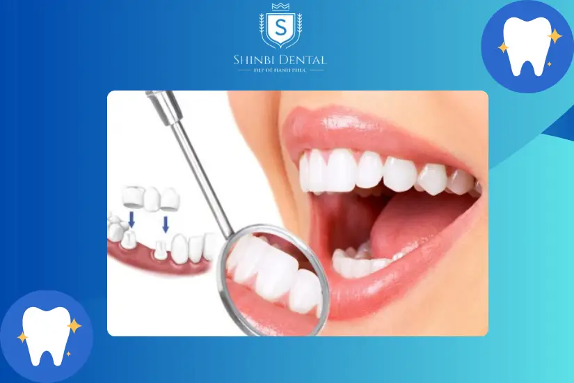 Các yếu tố tác động tới giá răng sứ không kim loại Các yếu tố tác động tới giá răng sứ không kim loại