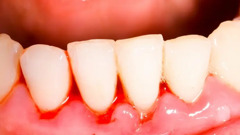 Dấu hiệu bị nha chu Dấu hiệu bị nha chu