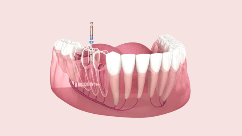 Dấu hiệu răng cần điều trị tủy Dấu hiệu răng cần điều trị tủy