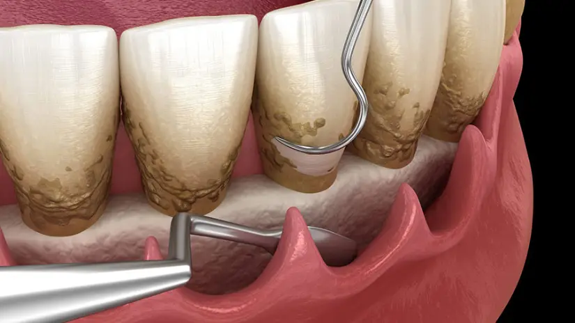 Điều trị bệnh nha chu không phẫu thuật Điều trị bệnh nha chu không phẫu thuật
