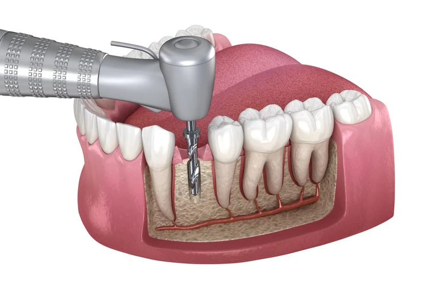 Điều trị tủy là một quy trình nha khoa nhằm loại bỏ phần tủy răng bị viêm nhiễm hoặc chết Điều trị tủy là một quy trình nha khoa nhằm loại bỏ phần tủy răng bị viêm nhiễm hoặc chết
