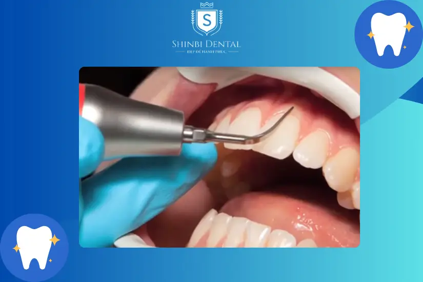 Điều trị viêm nha chu Điều trị viêm nha chu