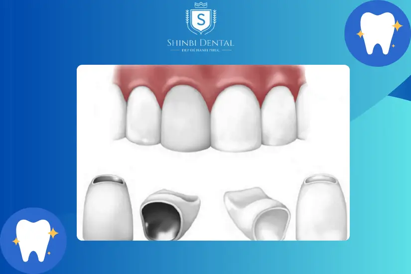 Gắn mão sứ vào răng