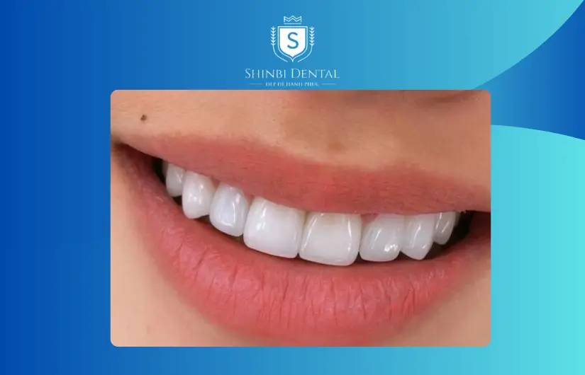 Giá bọc răng sứ Lava Giá bọc răng sứ Lava