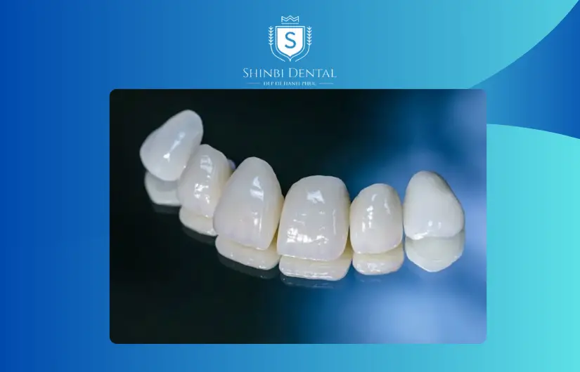 Giá bọc răng sứ bị ảnh hưởng bởi loại răng sứ Giá bọc răng sứ bị ảnh hưởng bởi loại răng sứ
