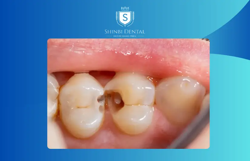 Giá bọc răng sứ bị ảnh hưởng bởi tình trạng răng Giá bọc răng sứ bị ảnh hưởng bởi tình trạng răng