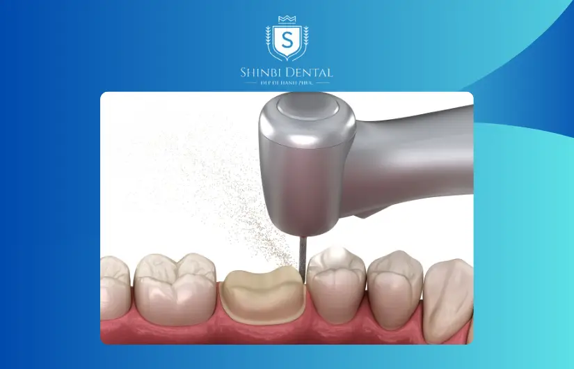 Giá mài răng bọc sứ có thể dao động từ 1 triệu đến 10 triệu đồng cho mỗi răng Giá mài răng bọc sứ có thể dao động từ 1 triệu đến 10 triệu đồng cho mỗi răng