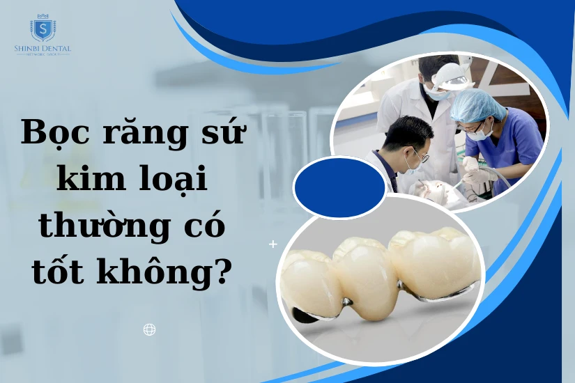 Giải đáp bọc răng sứ kim loại thường có tốt không? Giải đáp bọc răng sứ kim loại thường có tốt không?