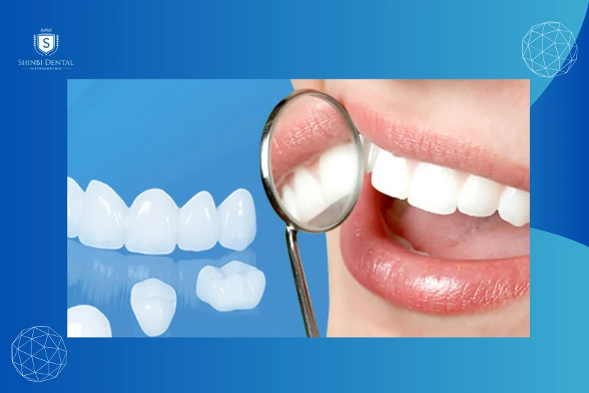 Giải đáp bọc răng sứ toàn sứ là gì