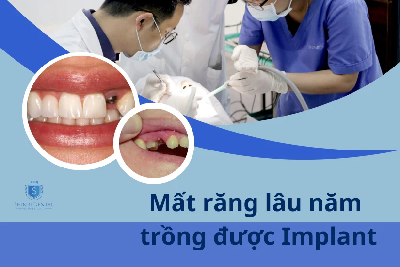 Giải đáp mất răng lâu năm có trồng implant được không