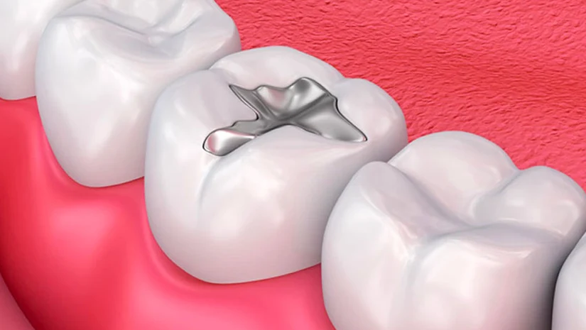 Hàn trám răng giúp phục hồi răng bị sâu, vỡ, mẻ hoặc tổn thương Hàn trám răng giúp phục hồi răng bị sâu, vỡ, mẻ hoặc tổn thương
