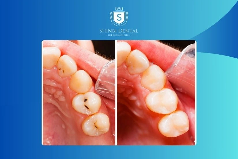 Không nên bọc răng sứ giá rẻ Không nên bọc răng sứ giá rẻ