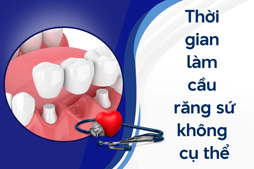 Làm cầu răng sứ không có thời gian cụ thể Làm cầu răng sứ không có thời gian cụ thể