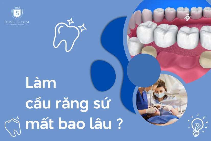 Làm cầu răng sứ mất bao lâu? Các yếu tố ảnh hưởng