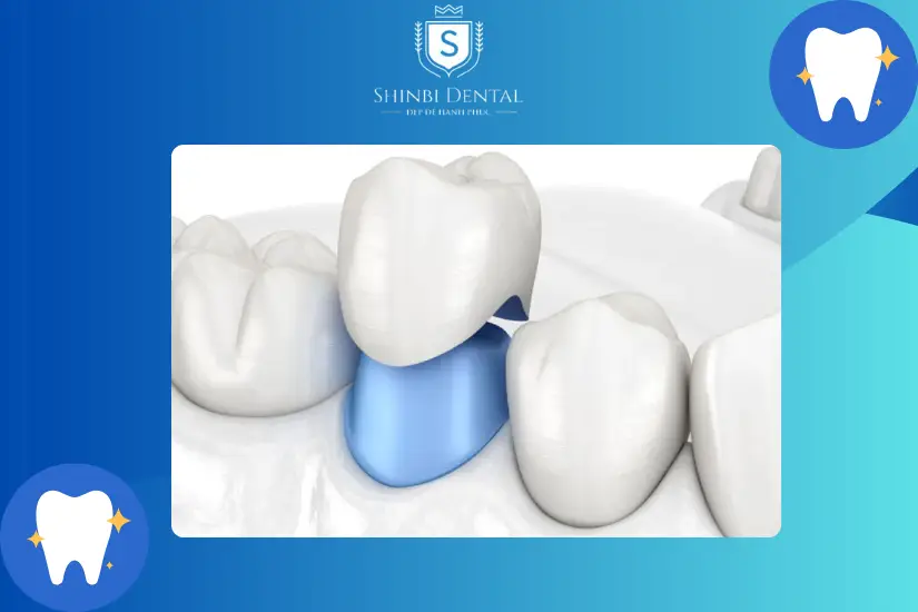 Thời gian làm răng sứ dao động từ 1-2 tuần, nhanh hơn là 5-7 ngày