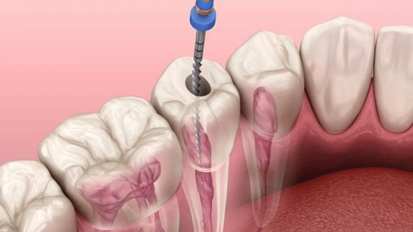 Lý do cần điều trị tủy răng Lý do cần điều trị tủy răng