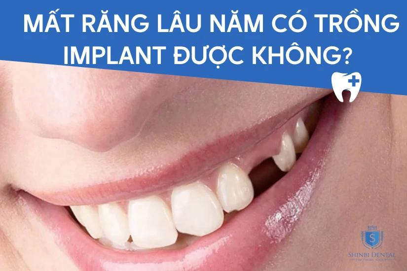 Mất răng lâu năm có trồng Implant được không? Mức giá