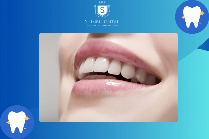 Chỉ nên bọc sứ cho răng cửa bị hô nhẹ Chỉ nên bọc sứ cho răng cửa bị hô nhẹ