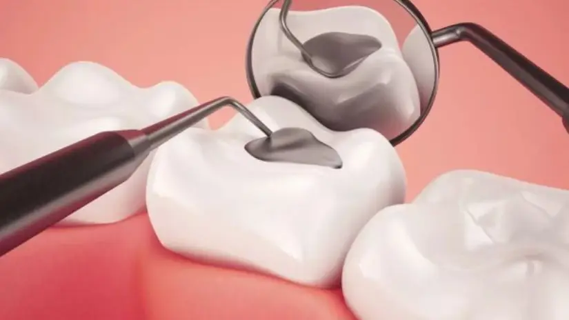 Những trường hợp nên hàn trám răng Những trường hợp nên hàn trám răng