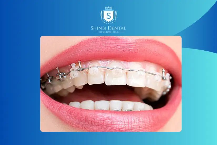 Dịch vụ niềng răng Dịch vụ niềng răng