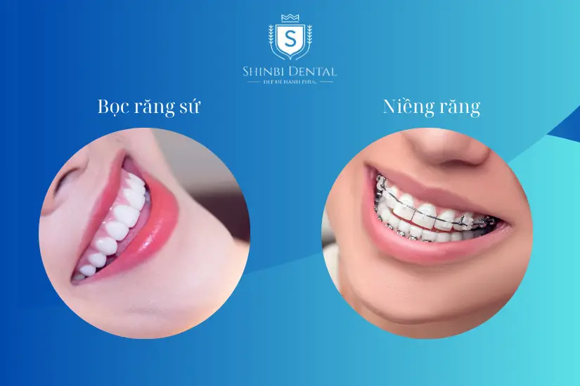 Răng thưa có thể được khắc phục bằng cả niềng răng và bọc răng sứ